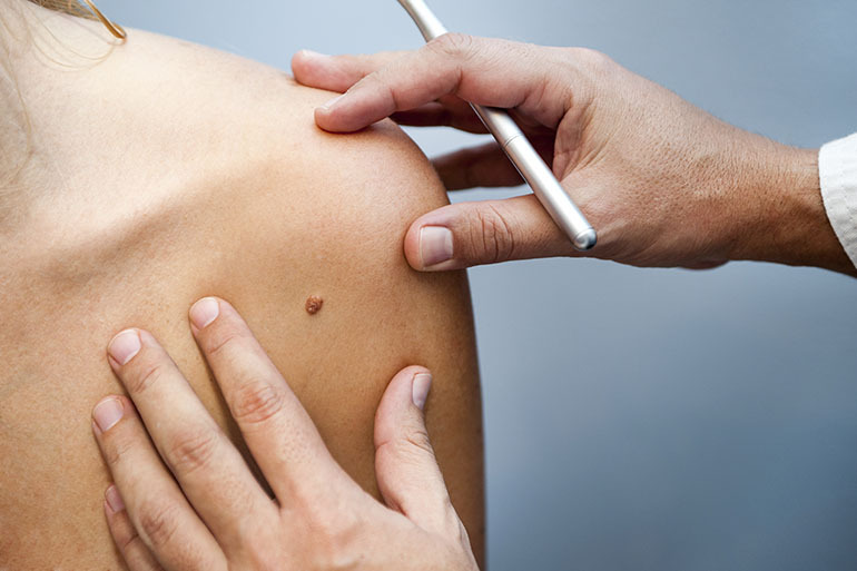 Mole on a woman's arm examined for skin care by medical dermatologist.