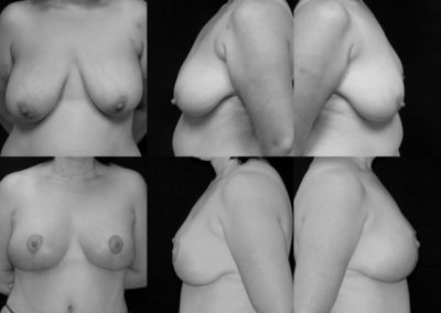 Before and after comparison photos of a breast lift.