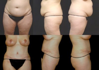 Before and after photos of a woman's tummy tuck.