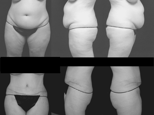 Before and after photos of a woman's tummy tuck.