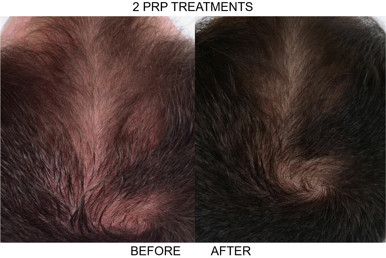 Platet Rich Plasma hair loss treatment before and after comparison