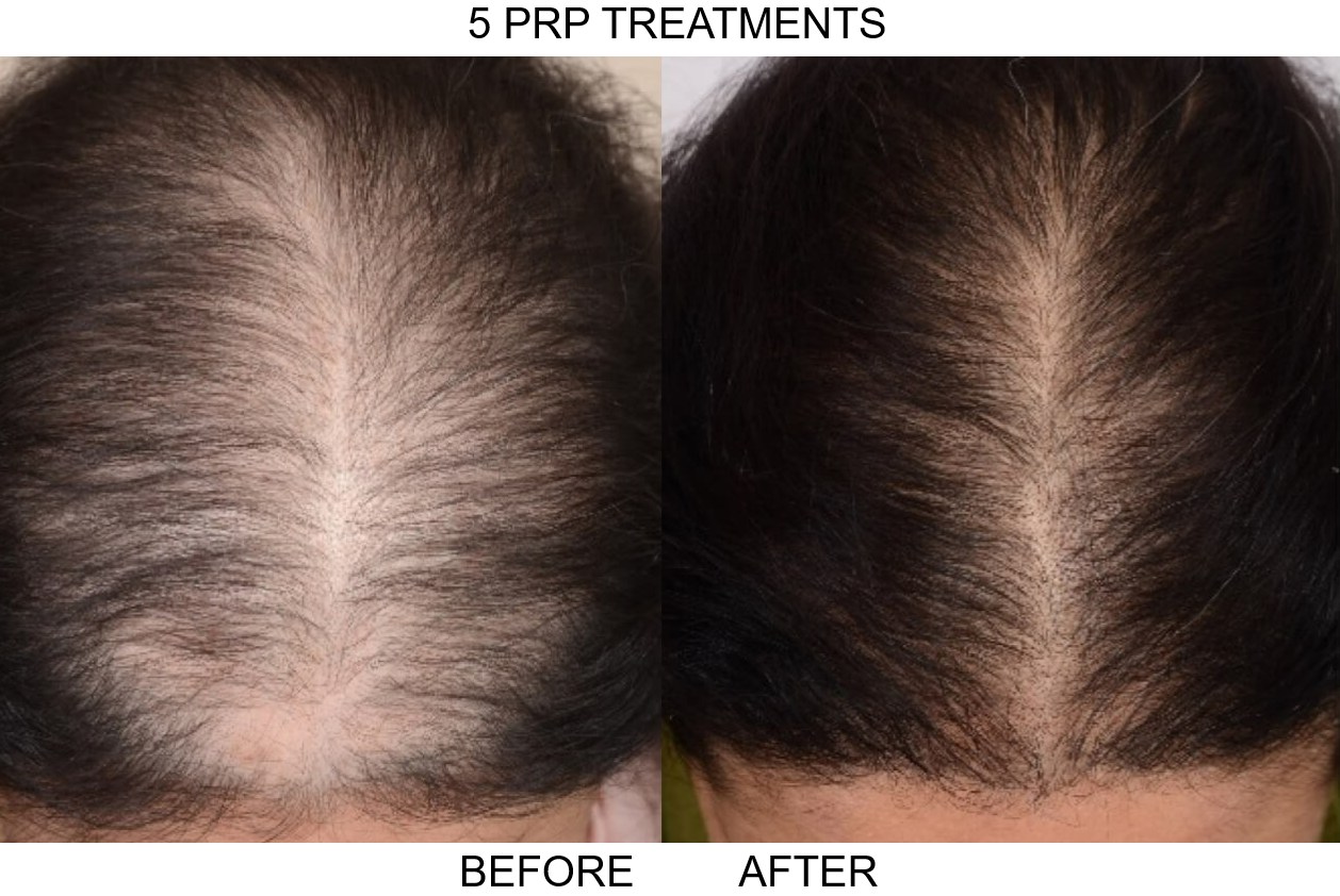 Platet Rich Plasma hair loss treatment before and after comparison