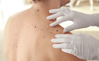 What to Expect During a Skin Check