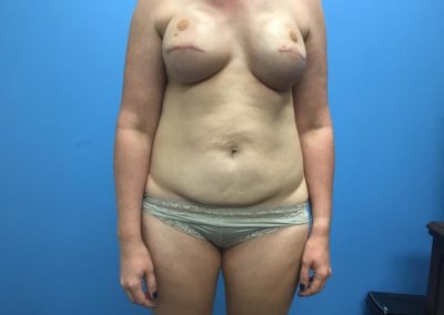 Bilateral breast reconstruction after filler injection front view of patient's chest and abdomen.