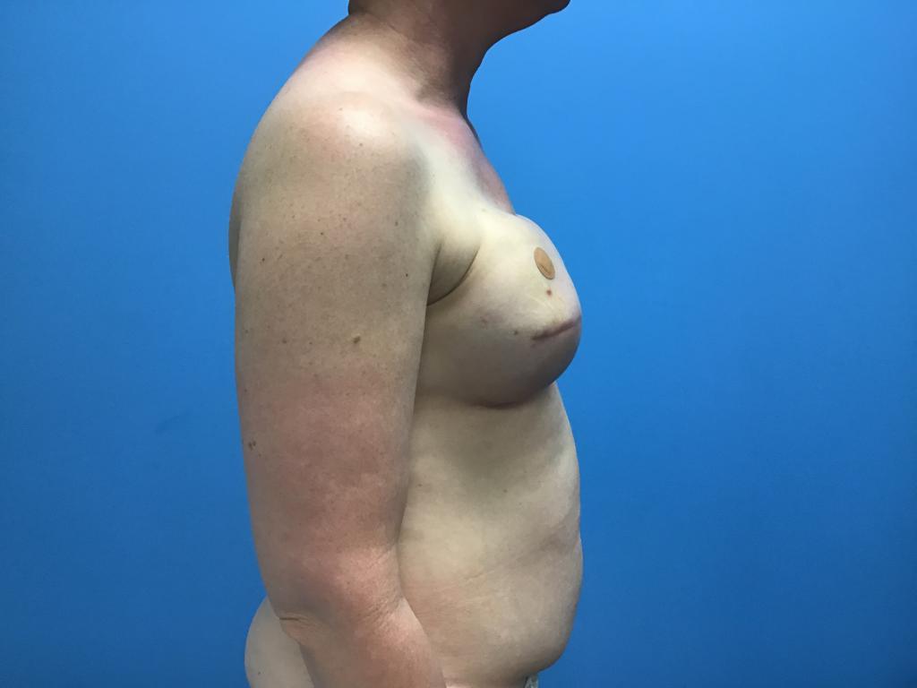 Bilateral breast reconstruction after filler injection side view of patient's chest and abdomen.