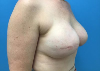 Breast and nipple reconstruction before procedure side view of patient's chest.