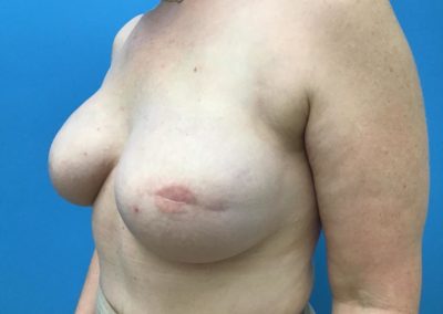 Breast and nipple reconstruction before procedure front view of patient's chest.