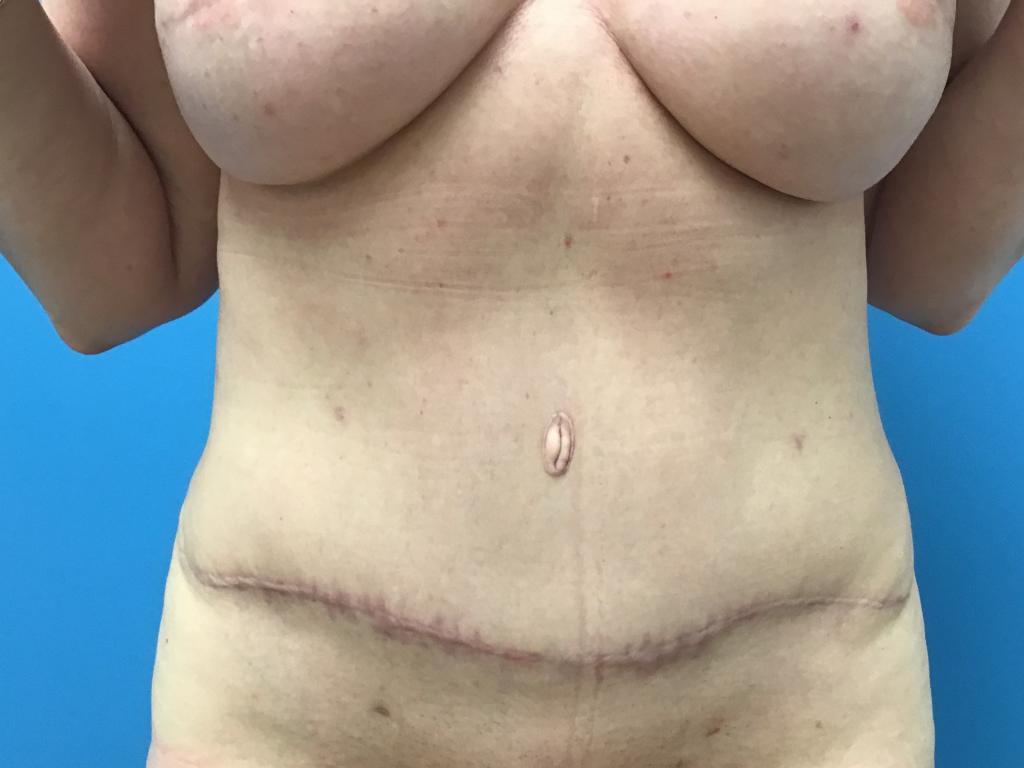 Tummy tuck abdominoplasty patient after front view of healing scar.