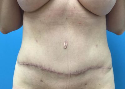 Tummy tuck abdominoplasty patient after front view of healing scar.