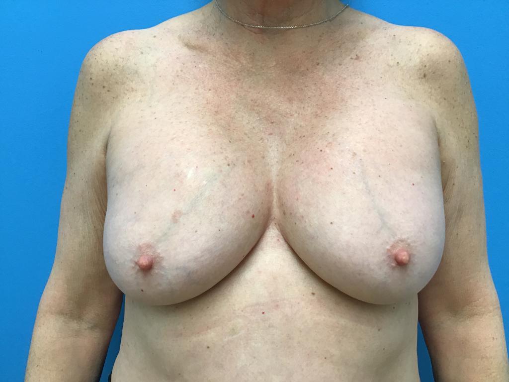 Breast augmentation before photo front view of patent's chest.