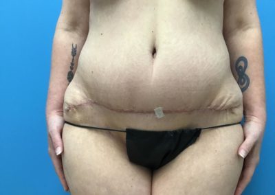 Tummy tuck abdominoplasty patient after front view picture.