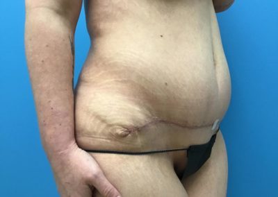 Tummy tuck abdominoplasty patient after side view picture.