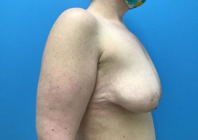 Breast reconstruction patient before side view of chest.