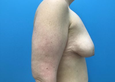 Breast reconstruction patient before side view of chest.