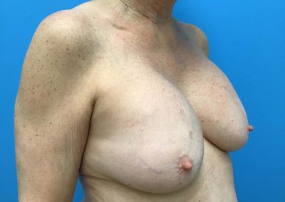 Breast augmentation before photo side view of patent's chest.