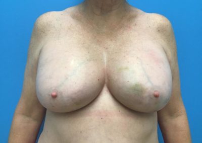 Breast augmentation after photo front view of patent's chest.