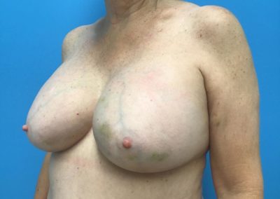 Breast augmentation after photo side view of patent's chest.