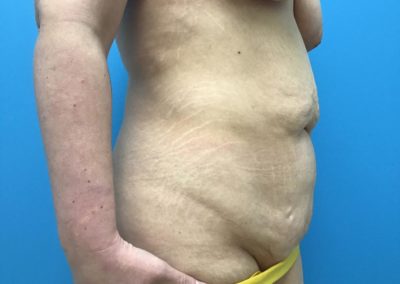 Tummy tuck abdominoplasty patient before side view picture.