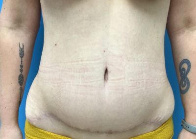 After mommy makeover tummy tuck