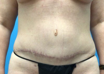 After photo of a woman's tummy tuck.