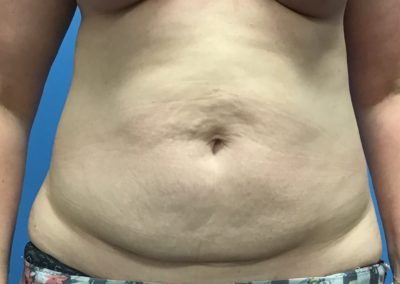 Before photo of a woman's tummy tuck.