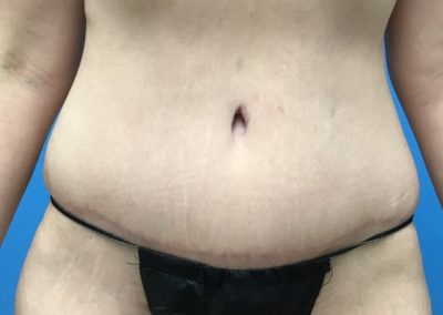 After tummy tuck liposuction