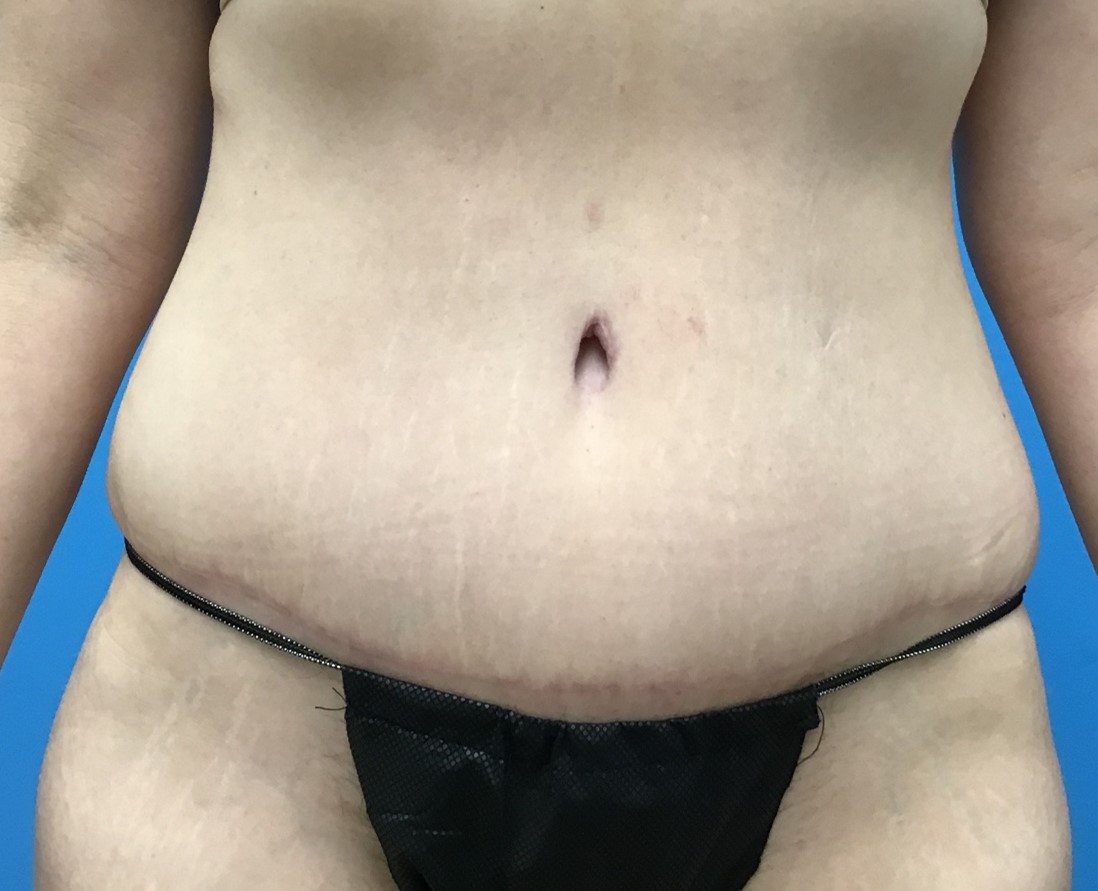 After tummy tuck liposuction