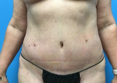 After photo of a woman's tummy tuck.
