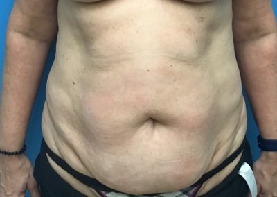 Before photo of a woman's tummy tuck.